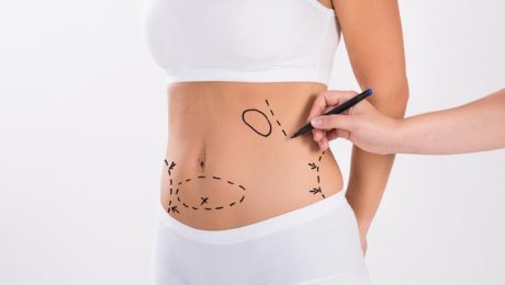 Liposuction or Tummy Tuck: Which Is Right for You?