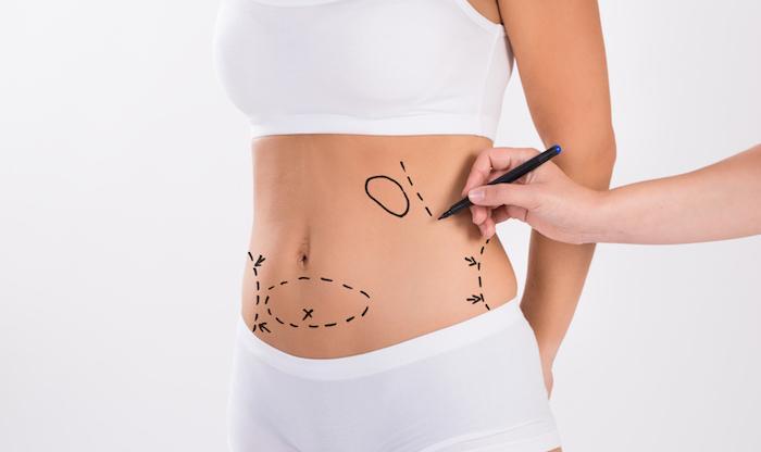 Liposuction or Tummy Tuck: Which Is Right for You? - L. A. Vinas