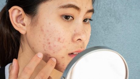 8 Treatment Options for Acne