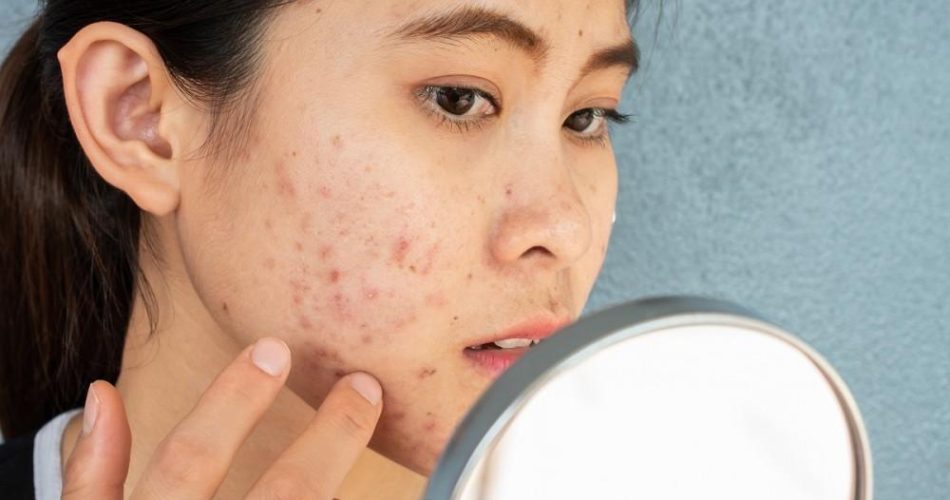 8 Treatment Options for Acne