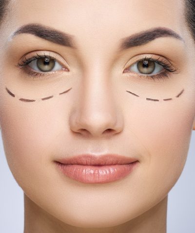 Blepharoplasty (Eyelid Surgery)