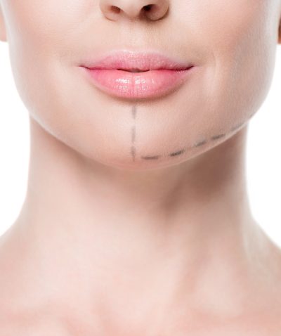 Chin Augmentation