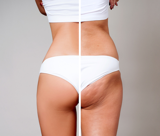 Fat Grafting Technique for Buttock Augmentation