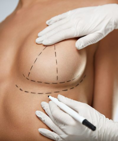 Breast Lift