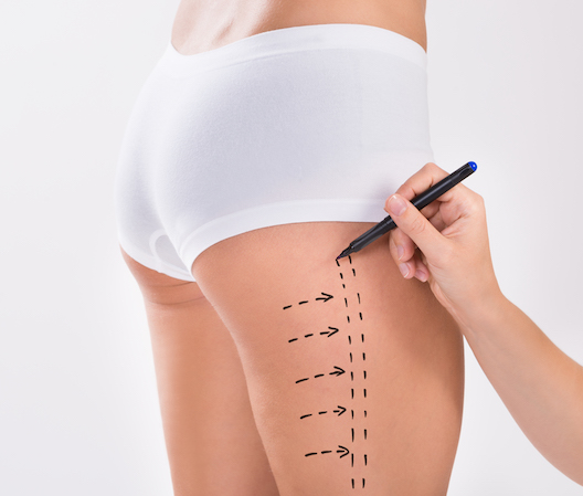 Thigh Lift Procedure