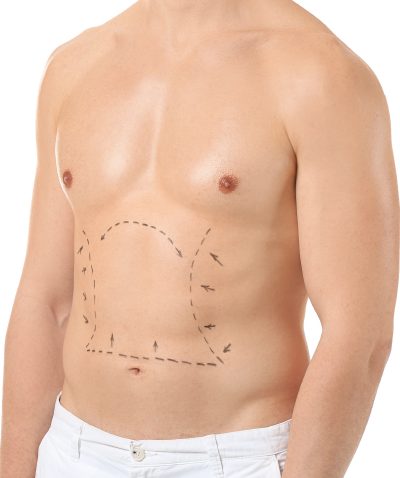 Male Liposuction