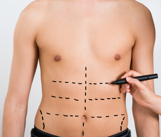 Male Liposuction May be Right for You