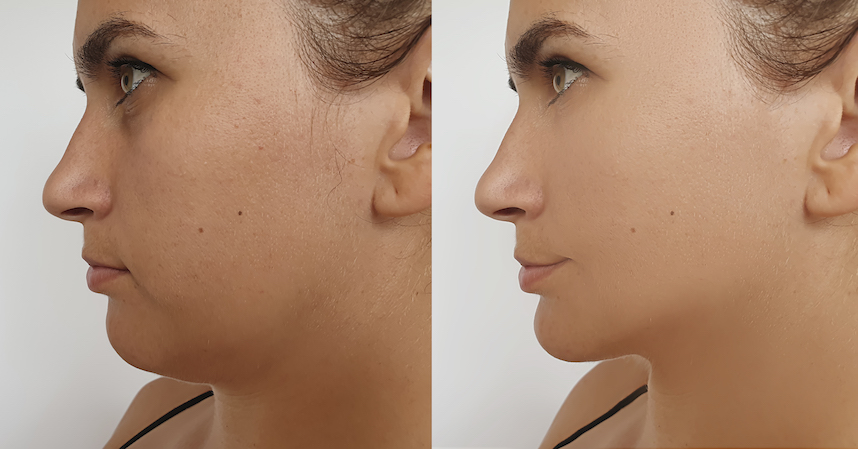 Jaw Fillers at L.A. Vinas