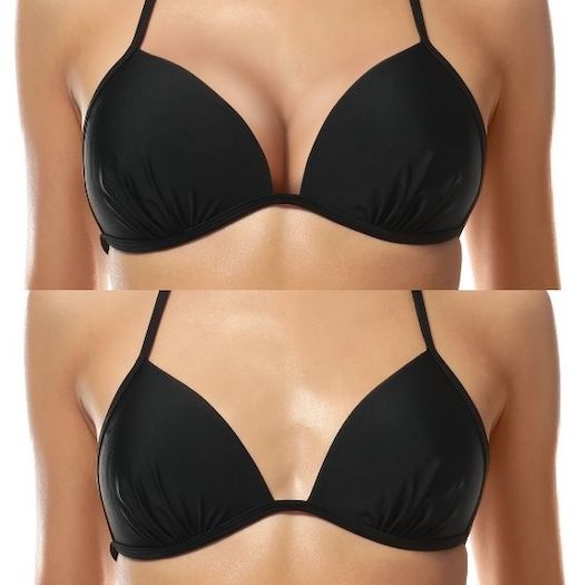 Breast Reduction Procedure