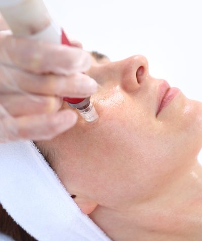 Microneedling