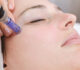 Revitalize Skin With Microneedling Treatments at L.A. Vinas
