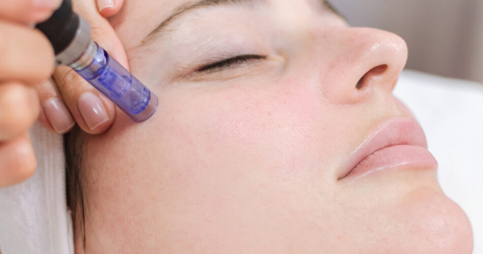 Revitalize Skin With Microneedling Treatments at L.A. Vinas