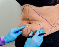 Who is the Ideal Candidate for a Tummy Tuck Procedure?