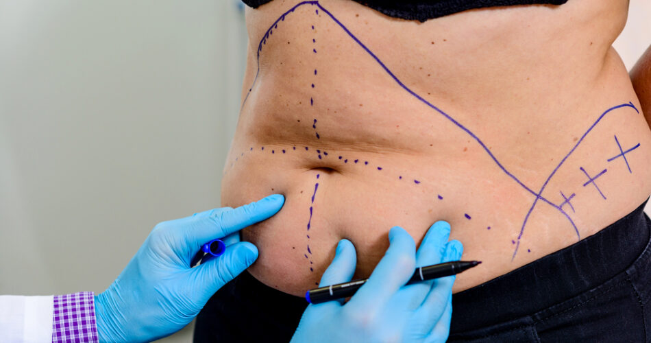 Who is the Ideal Candidate for a Tummy Tuck Procedure?