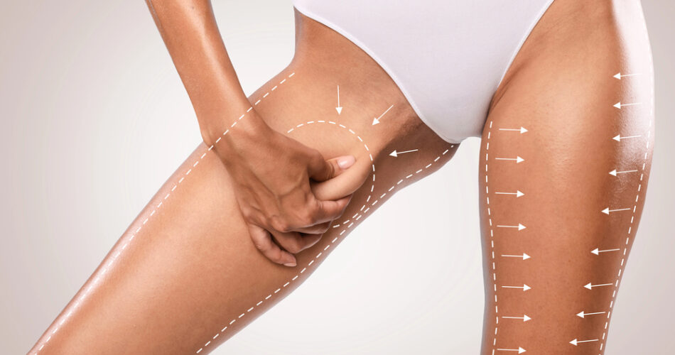 Understanding Thigh and Tummy Lifts: Are You a Candidate?