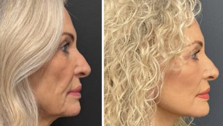 Get Holiday Ready: Why L.A. Vinas M.D. Recommends 3 Weeks of Healing for a V Lift Facelift