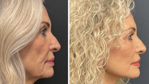 Get Holiday Ready: Why L.A. Vinas M.D. Recommends 3 Weeks of Healing for a V Lift Facelift
